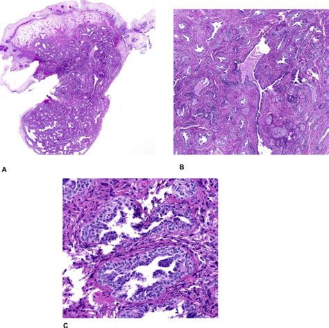 Ductal Type Mesonephric Duct Remnant Hyperplasia Distinguished From