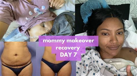 My Mommy Makeover In Tijuana Finally Back Home Day 7 Tummy Tuck Bbl Breast Lift 360 Lipo