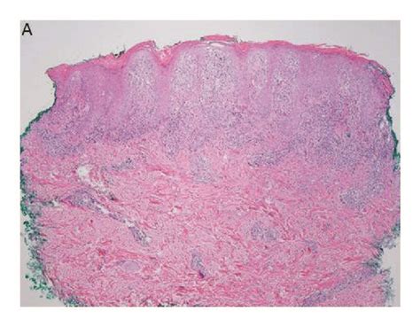 Hematoxylin Eosin Stained Biopsy Specimens From Left 2nd Digit A