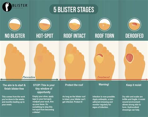 Blister Be Gone: 5 Proven Ways To Heal And Prevent Foot Blisters