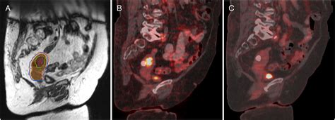 Online Adaptive Magnetic Resonance Guided Radiation Therapy For