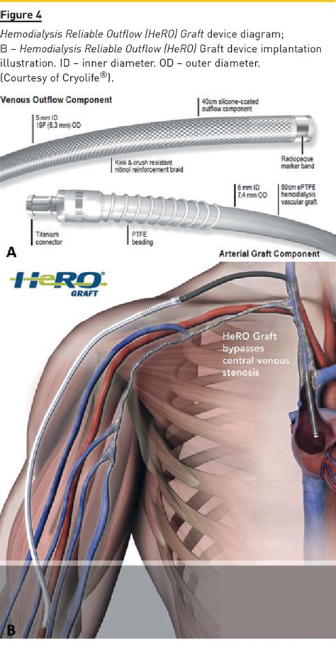 Figure 4 From Hemodialysis Reliable Outflow Hero Graft Device A