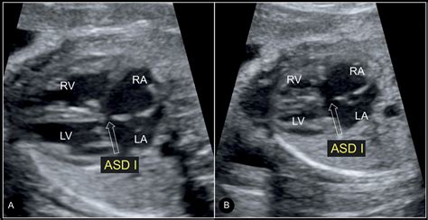 Ventricular Septal Defect Ultrasound