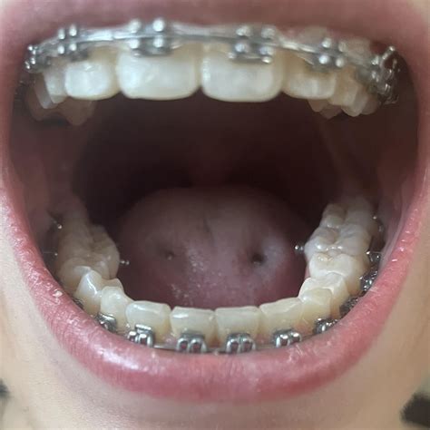 Molars slanted inward : r/braces