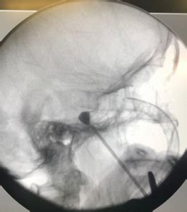 Neuralgia Do Trig Meo Como Saber Se Voc Possui Dr Thiago Rodrigues