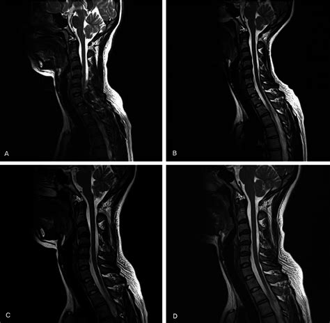 Serial T2-weighted sagittal MR images, (A) Heterogeneous lobulated ...