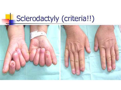 Systemic Sclerosis Ssc Alexandra Balbir Gurman Systemic Sclerosis