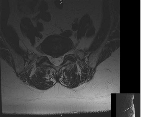 Lumbar MRI without contrast: axial view. MRI: magnetic resonance ...