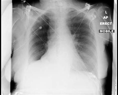 A Rare Complication Of Nasogastric Tube Insertion Bmj Case Reports