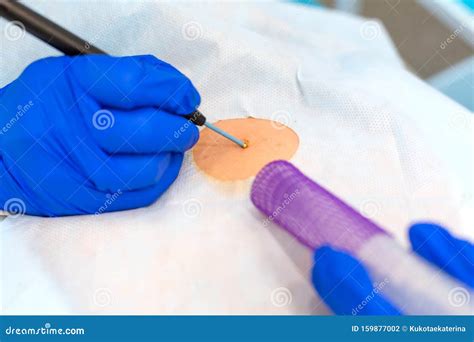 Close Up Surgeon Burns A Mole On The Back Of The Patient Mole Removal