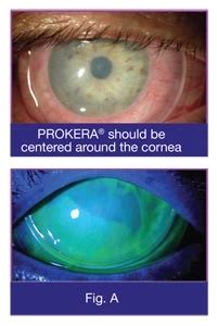 Prokera® Biological Corneal Bandage to Promote Regenerative Healing of ...