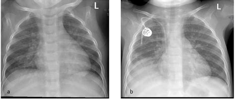 Chest X Ray On The Day Of Admission A Showing Peribronchial Cuffing