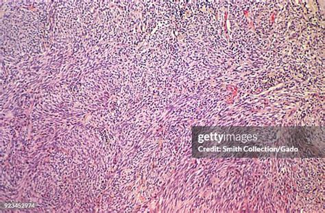 Kaposis Sarcoma Photos And Premium High Res Pictures Getty Images