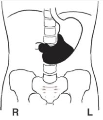 Chapter Biliary Tract And Upper Gastrointestinal System Flashcards