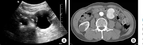 Figure 1 From A Case Of Superior Mesenteric Artery Aneurysm Mimicking