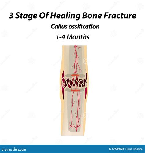 1 Stage Of Healing Bone Fracture. Formation Of Callus. Hematoma. The