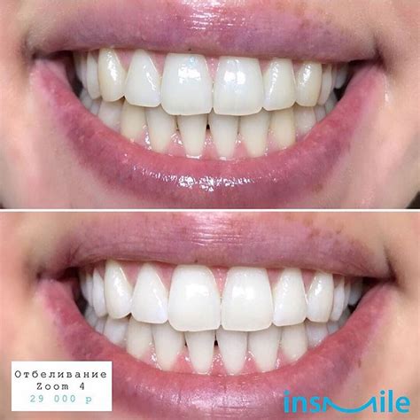Отбеливание зубов ZOOM 4 в Москве в клинике InSmile