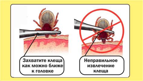 Первая помощь при укусе клеща