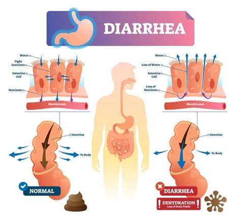 Having Diarrhea After Sex Critical Reasons Behind