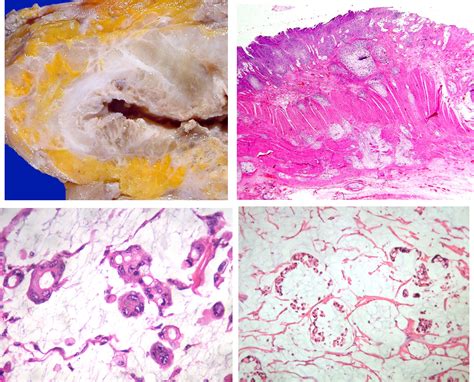 Macro E Micro Anatomia Patologica - PATOLOGÍA: II. GENERALIDADES DE DESCRIPCIÓN MACRO Y MICROSCÓPICA Y ...