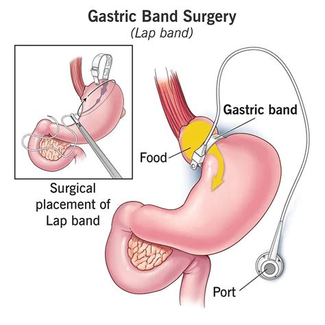 Gastric Band In Turkey Costs And Surgery Details