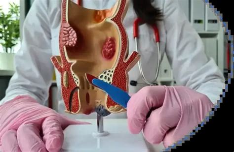 Anal Fistula Treatment In Bangladesh