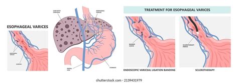 Esophageal Varices Banding