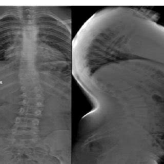 Severe Kyphosis In A Year Old Female With Cah And Glucocorticoid