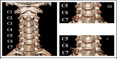 Uncovertebral Joint Hypertrophy Mri