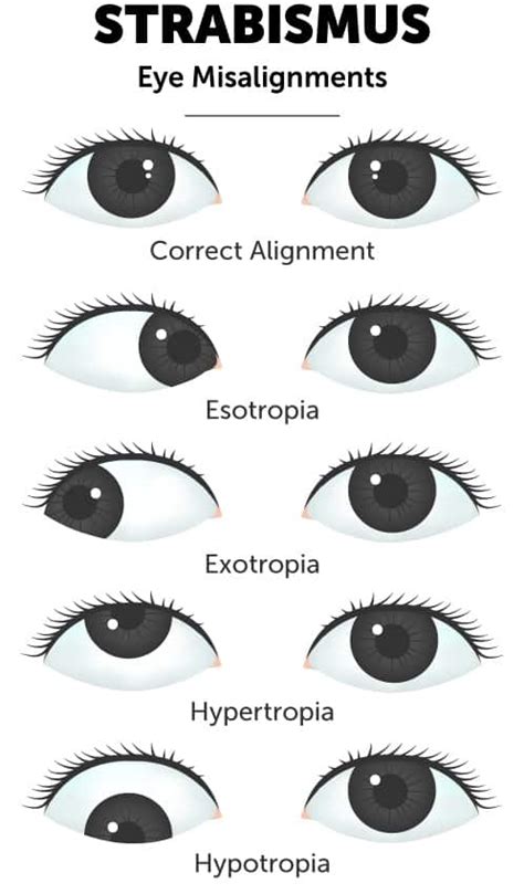 Strabismus Treatment And Surgery Wolfe Eye Clinic