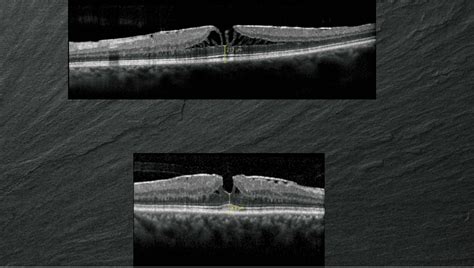 Distinction between lamellar holes and macular pseudoholes