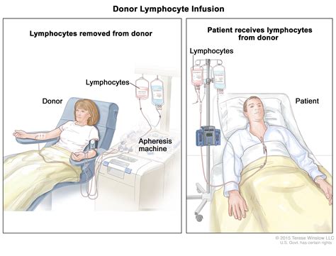 Definition Of Donor Lymphocyte Infusion Nci Dictionary Of Cancer