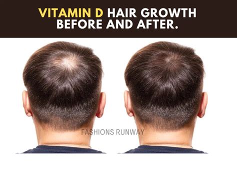 Vitamin D hair growth before and after. | Fashions Runway