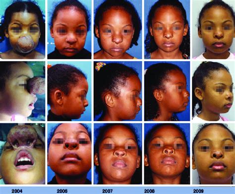 Mixed Infantile Hemangioma In The Proliferative Phase Affecting The