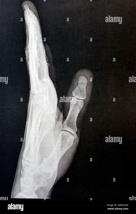 Plain X Ray Of The Left Hand Of An Adult Male After A Direct Trauma To
