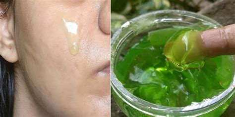 Learn How To Apply Aloe Vera Gel Everynight To Get Clean Skin The