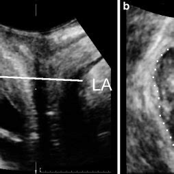 Determination Of Hiatal Dimensions By Transperineal Ultrasound The