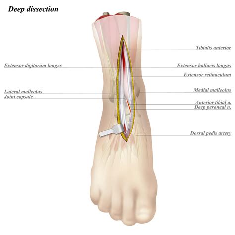 Ankle Anterior Approach - Approaches - Orthobullets