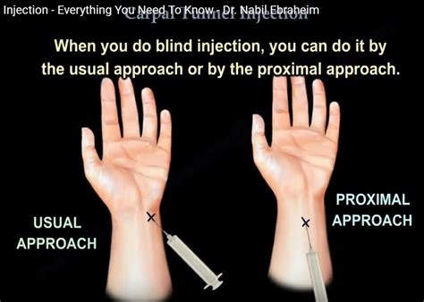 Carpal Tunnel Injection —