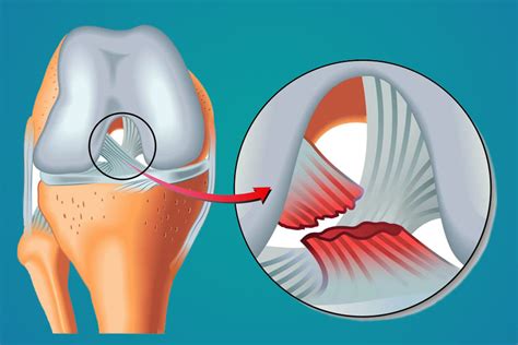 Anatomia Do Ligamento Cruzado Anterior Youtube