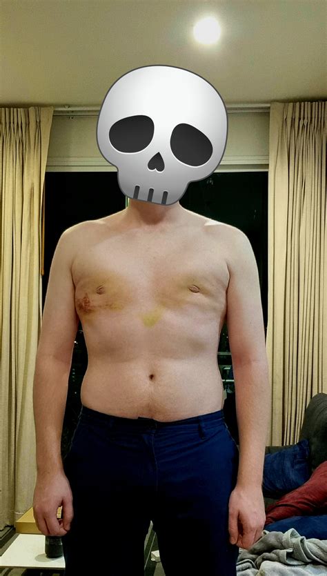 how much does it cost to remove gynecomastia