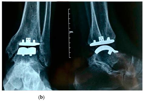 Clinical Radiographical Outcomes And Complications After A Brand New