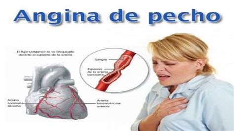 Angina De Pecho Mario Doctor UDocz