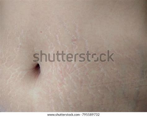 Women Belly Button After Pregnancy Childbirth Stock Photo 795589732 ...