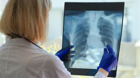 What Is ‘White Lung Syndrome’, Mysterious Pneumonia Outbreak Raising ...