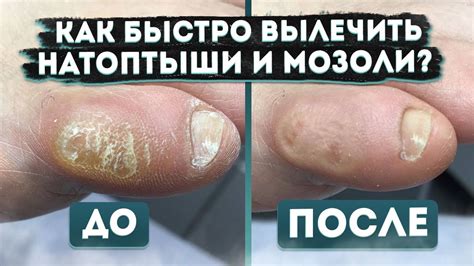 Как избавиться от сухой мозоли