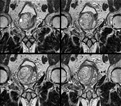 Benign Prostatic Hyperplasia Mri Stock Image C023 9709 Science