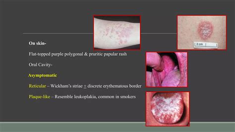 Precancerous Lesions Of Oral Cavity Ppt