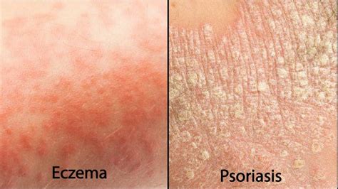 Eczema Vs Psoriasis Which One Do I Have Ultra Bee™