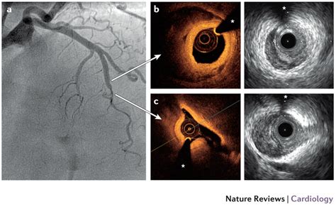 Optical Coherence Tomography OCT CathLab